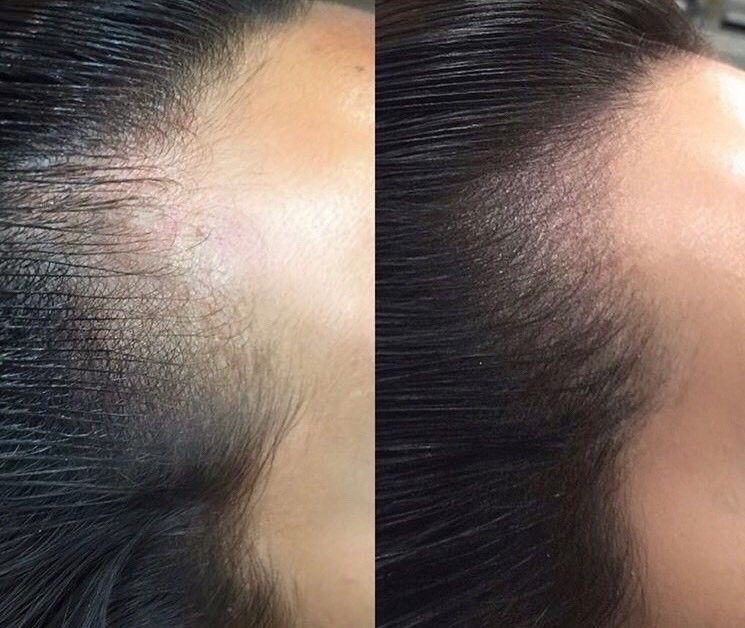 Hair Line Enhancement