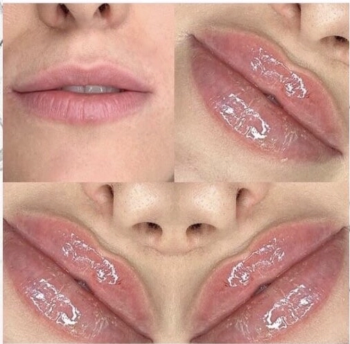 Lip Filler 1 ML