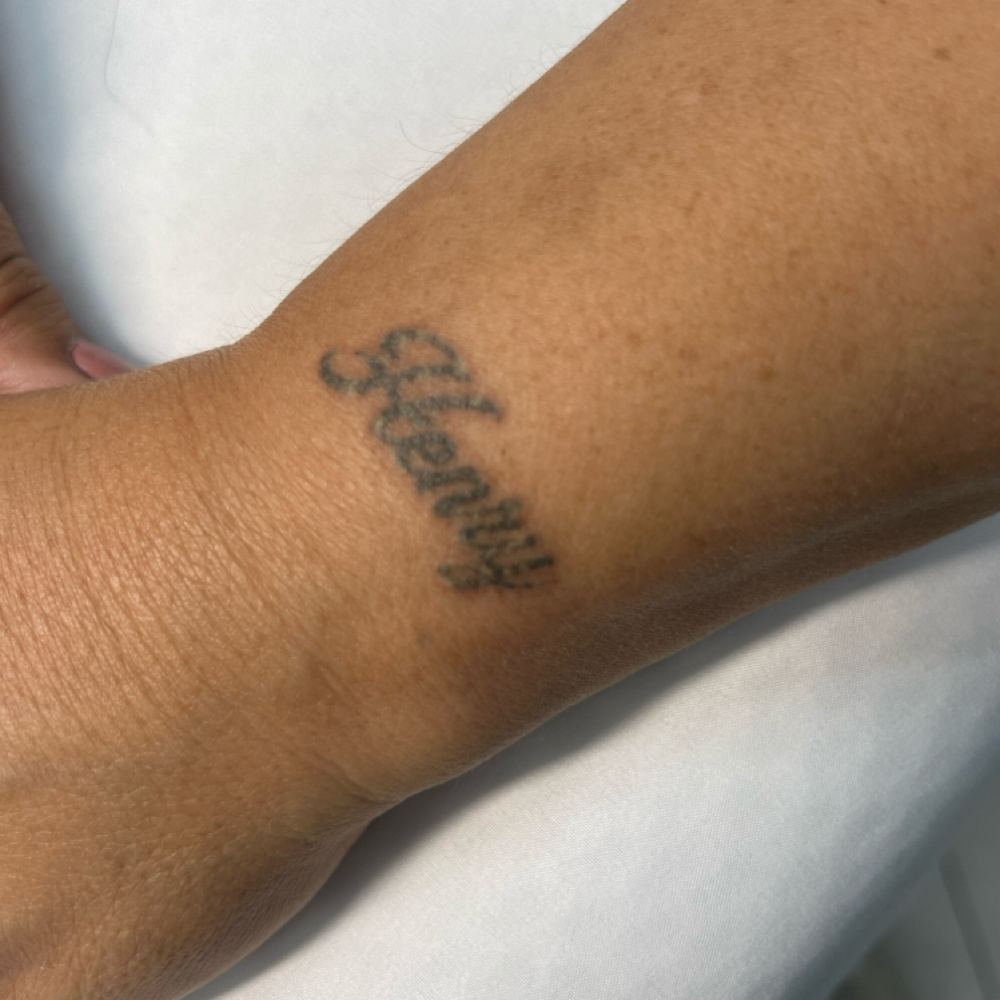 Tattoo Removal at Flow Ink & Beauty in Henderson, NV