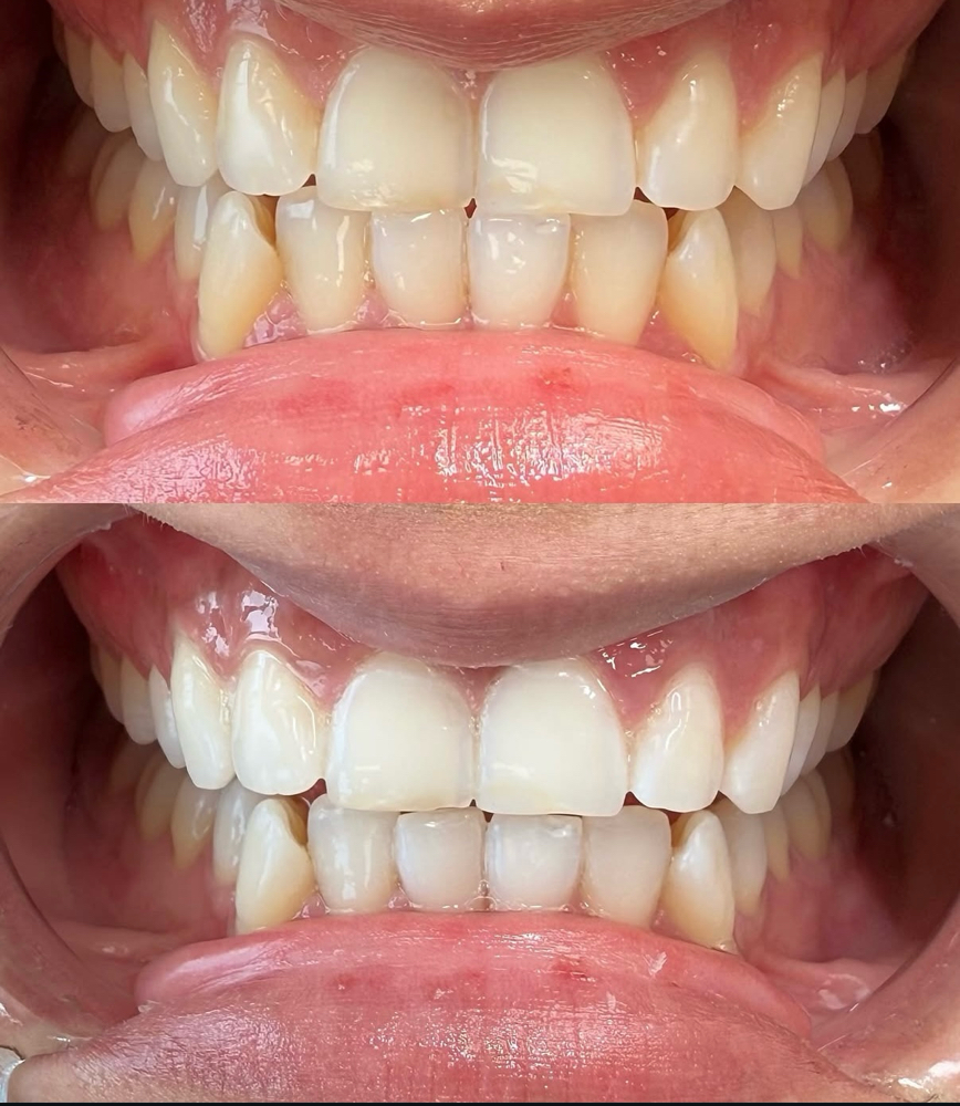 Teeth Whitening- 60 Minute Service