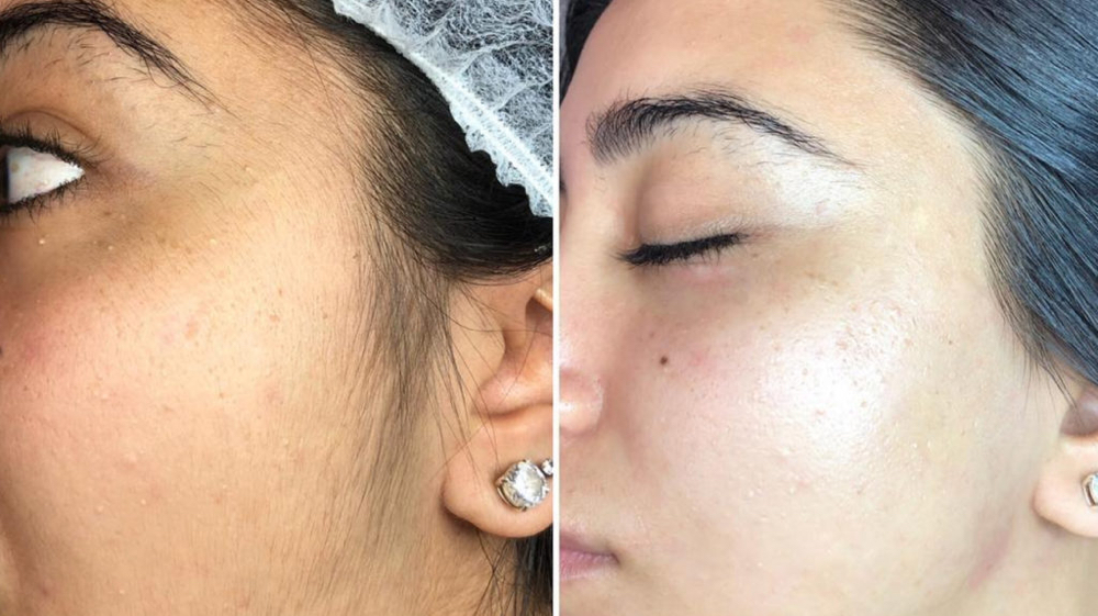 Luxe Dermaplaning
