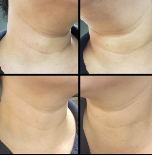 Double Chin Reduction Treatment