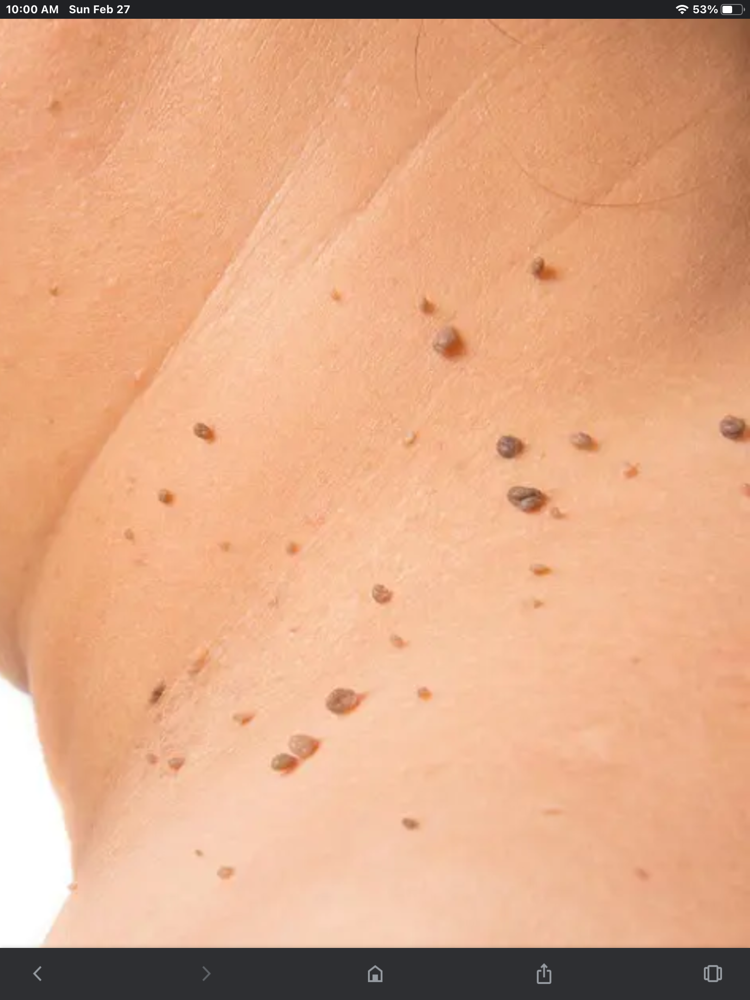Skin Tag Removal