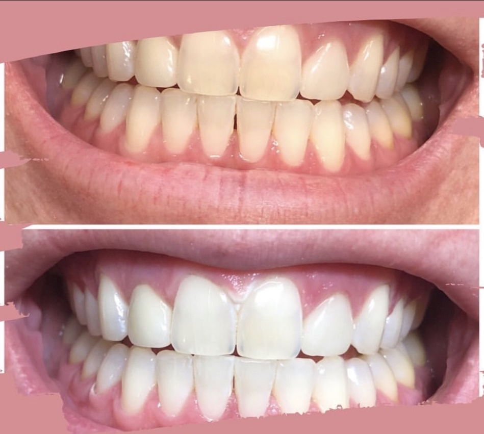 Dental Whitening - 1 Treatment