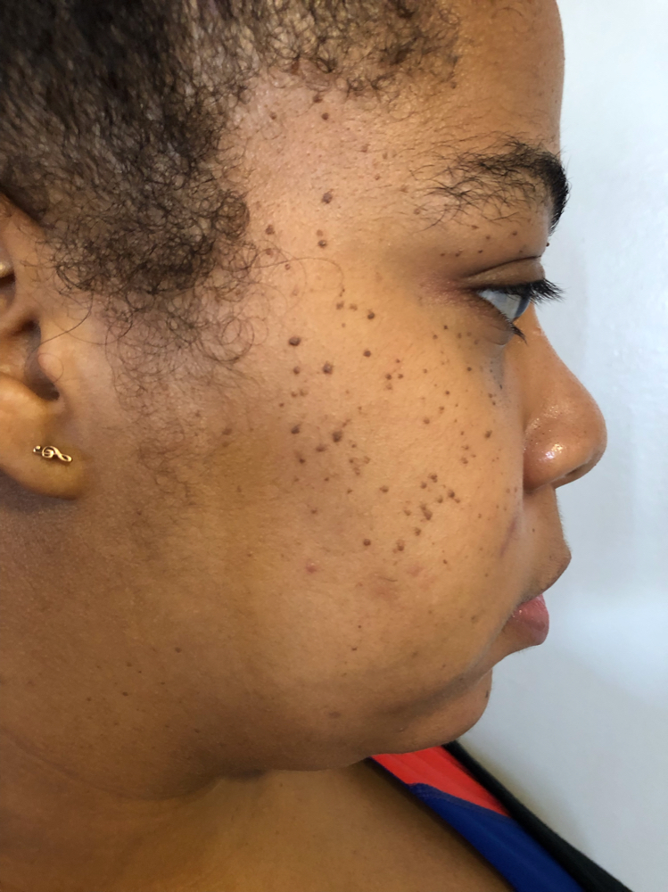 Dermatosis Papulosa Nigra Removal