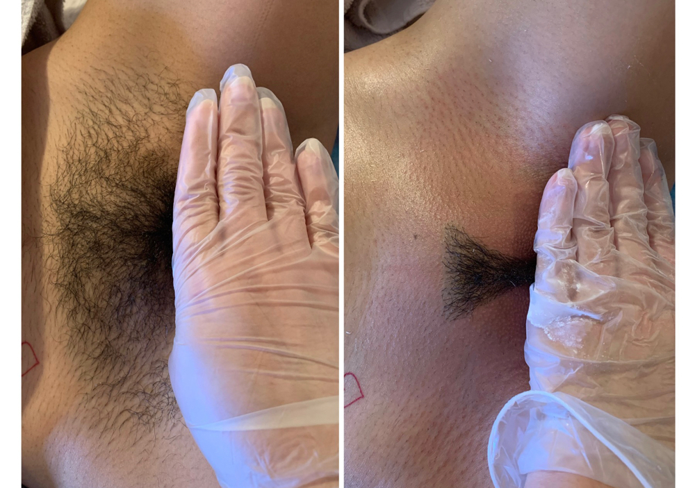 French Brazilian Wax