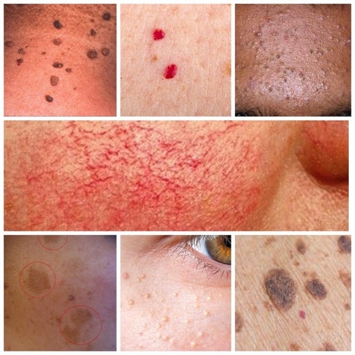 SKIN IRREGULARITIES TREATMENT