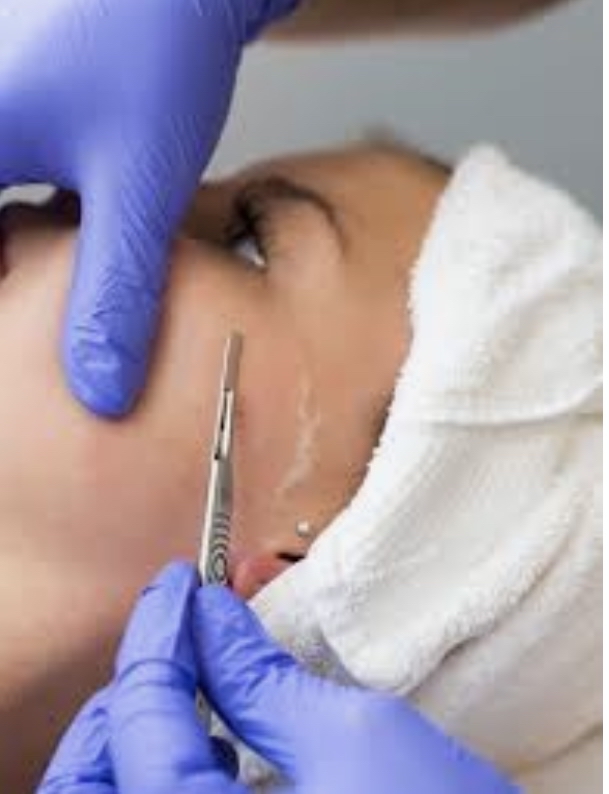 Dermaplaning