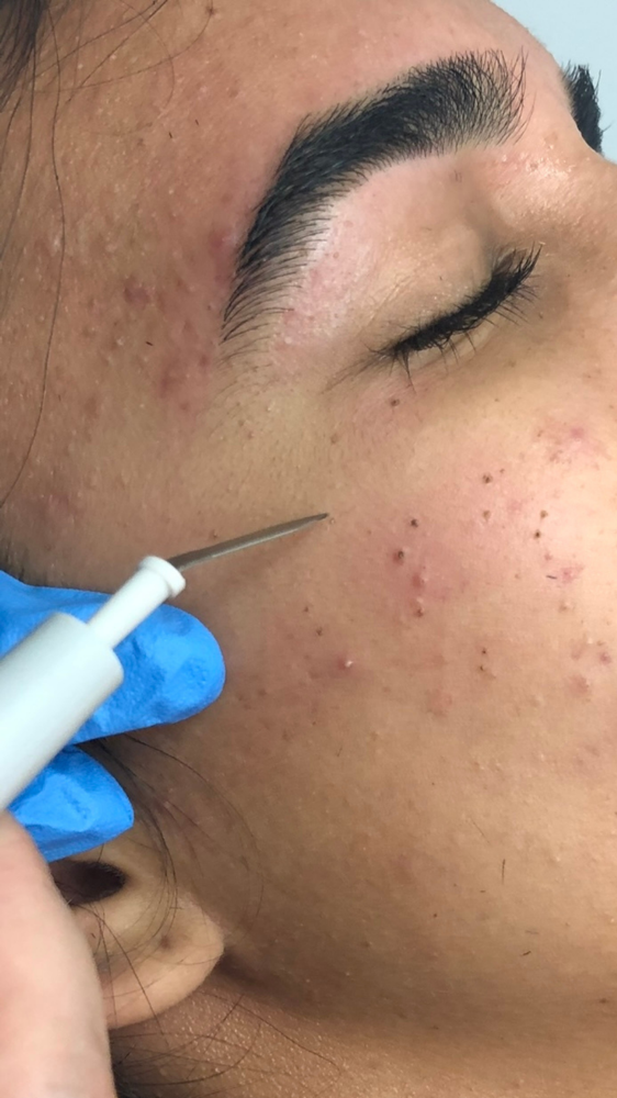 SKIN TAG REMOVAL