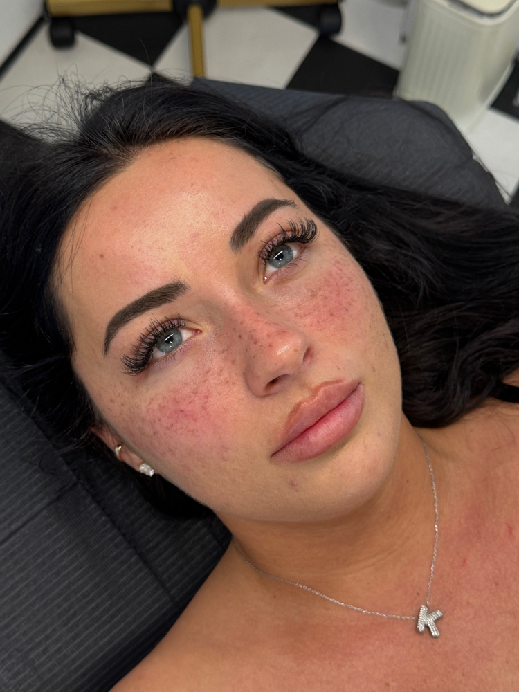 Freckles Medium - High Coverage