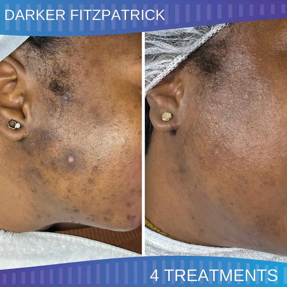 Collagen Recode Micro-Channeling at TouchedByTyHairCo in San Antonio, TX