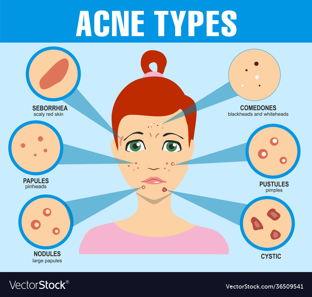 Anti-Acne Facial
