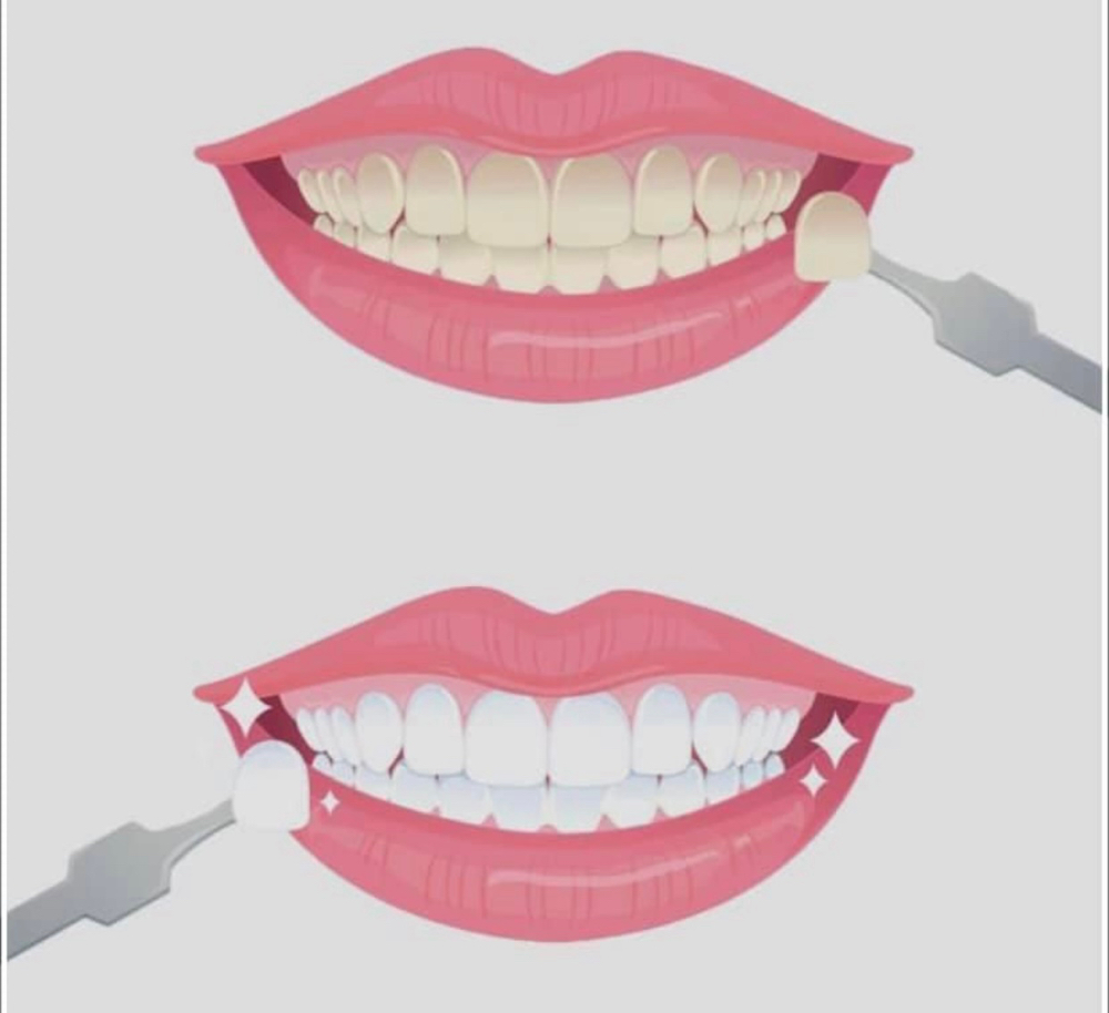 60 Min Whitening Session at Define Davina BEAUTY in Seattle, WA