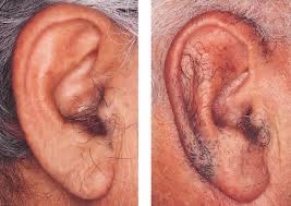 Ear Wax