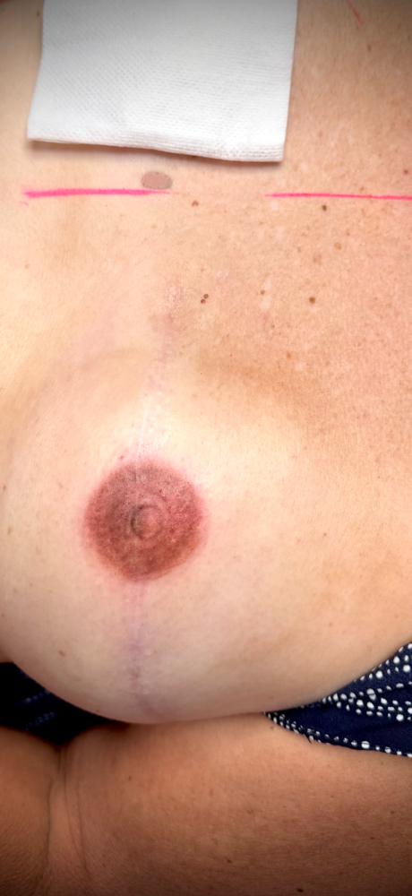 Areola Reconstruction PMU