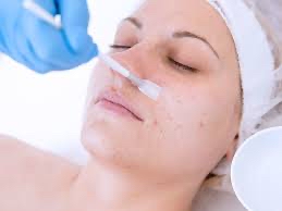 Chemical peel