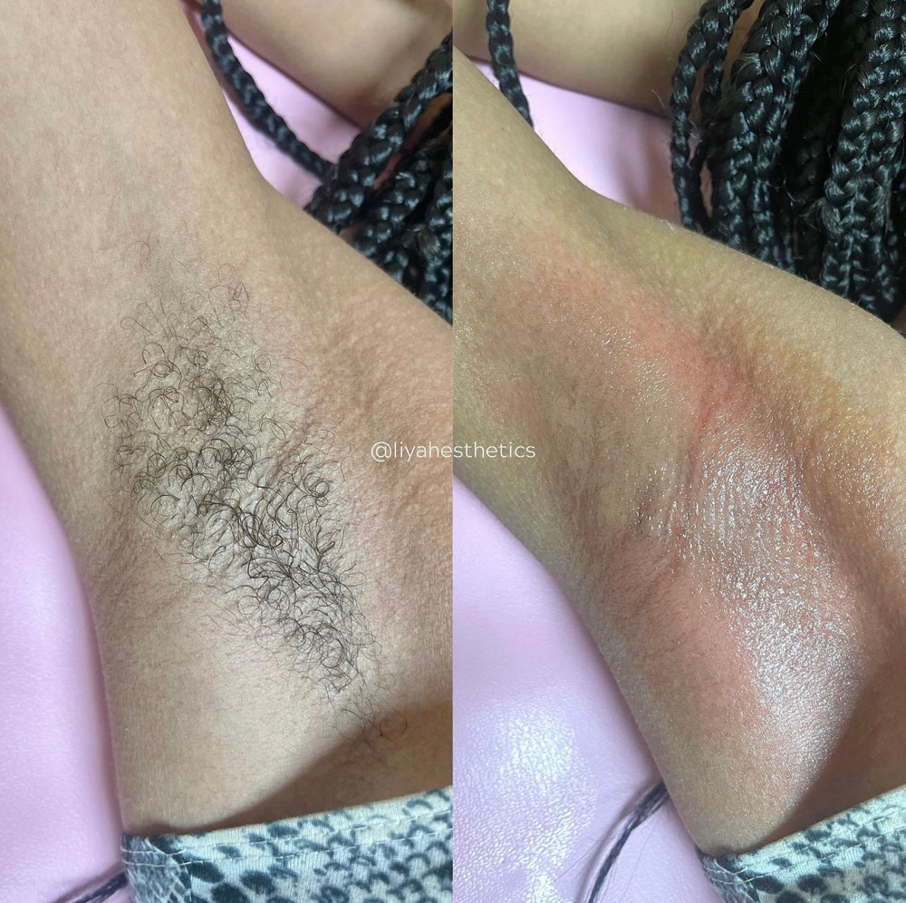 Underarms