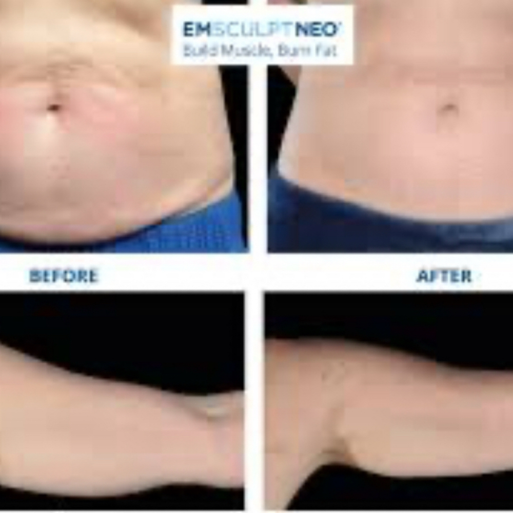 Emsculpt at Luxe Beauty Bar in Brookfield, CT