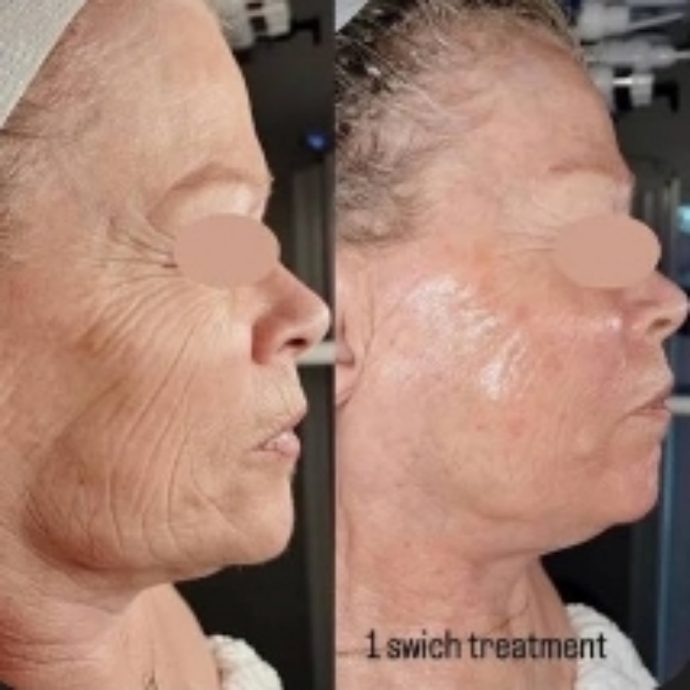SWiCH Dermal Rejuvenation System