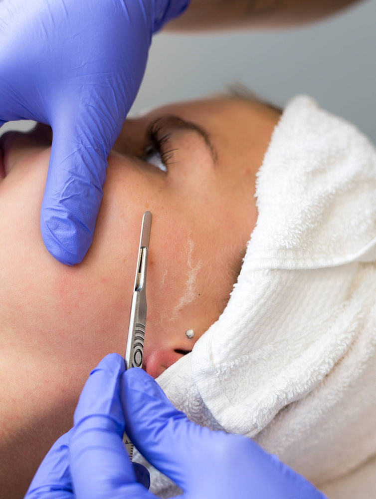 Dermaplane facial
