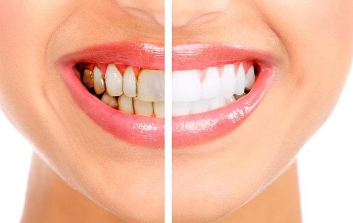 Elite Teeth Whitening