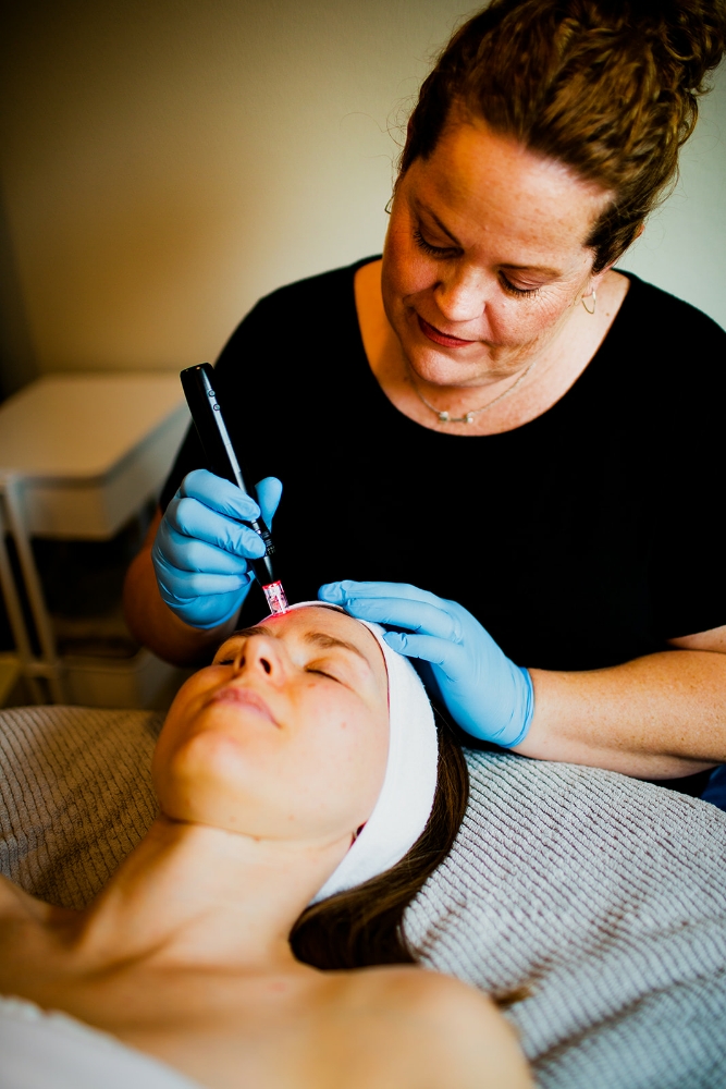 Microneedling