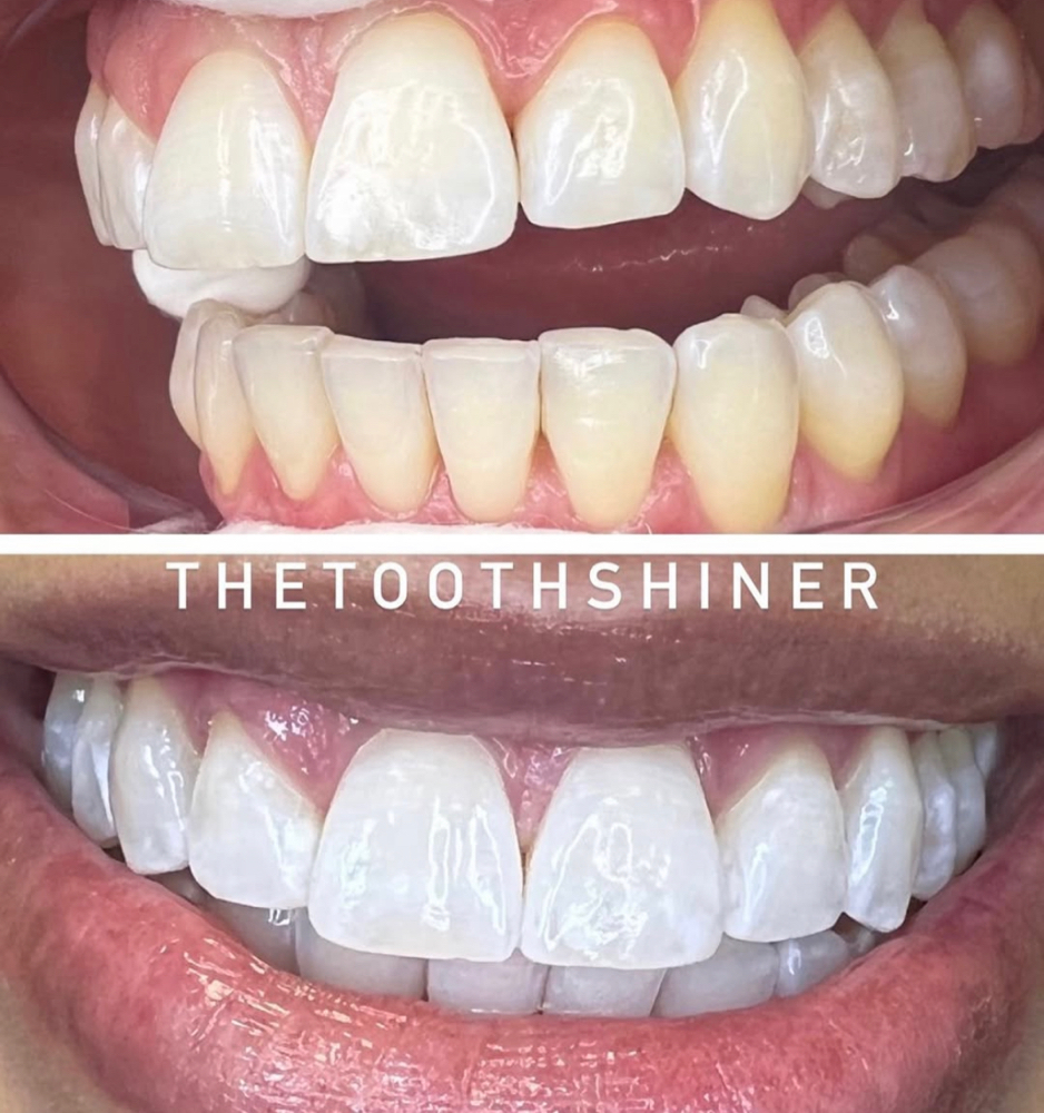 (Touch Up)90Min Pro Laser Whitening