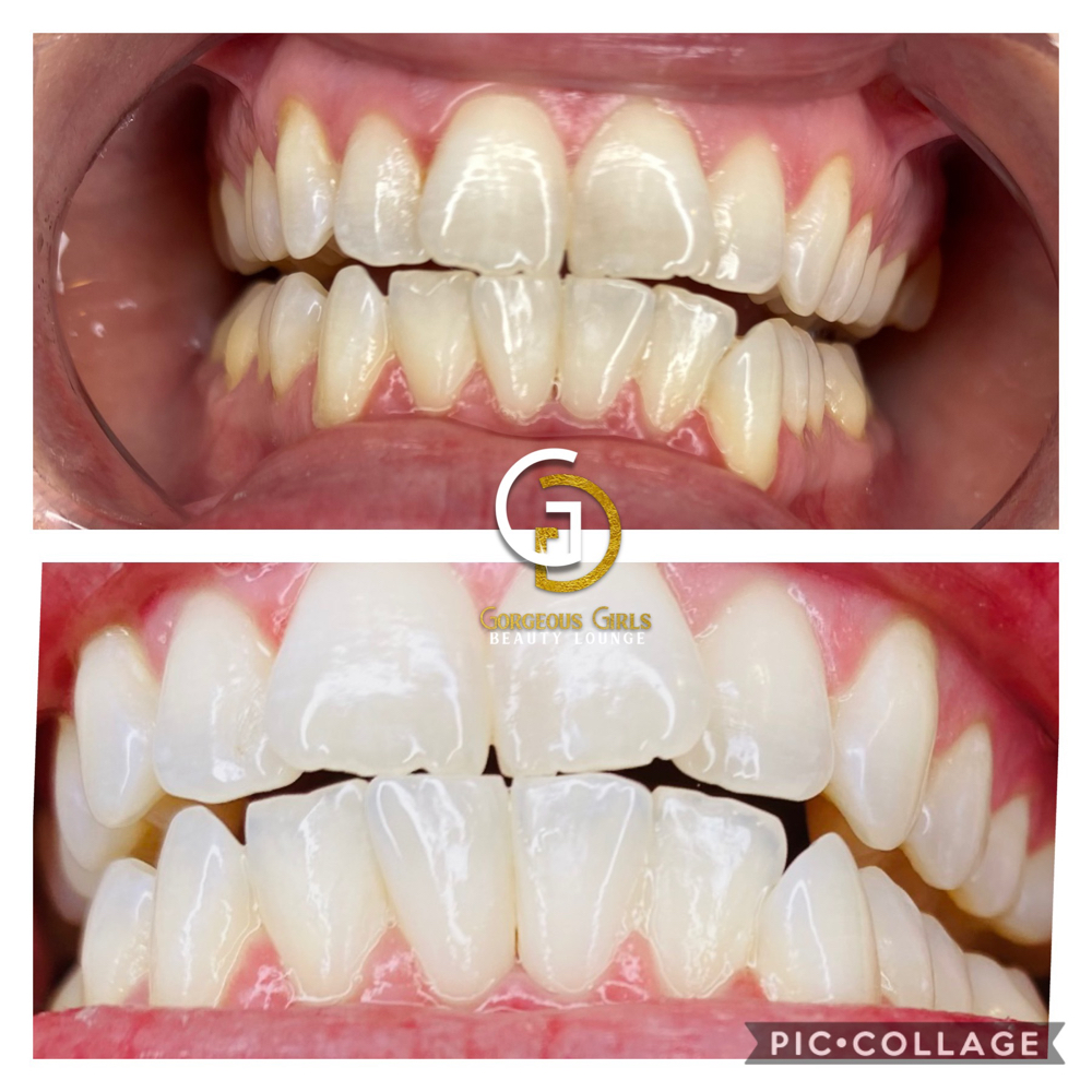 40 Min Teeth Whitening