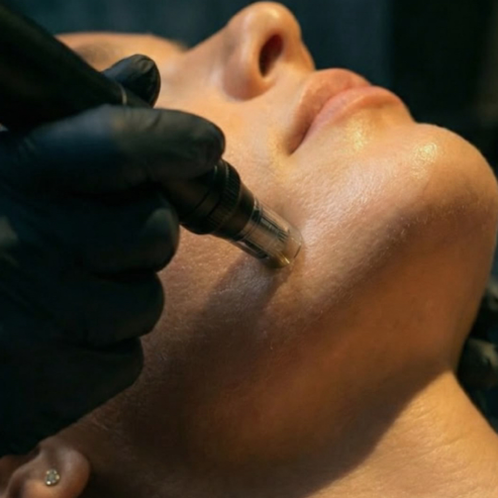 Microneedling at Elevate Aesthetics in Sandy, UT