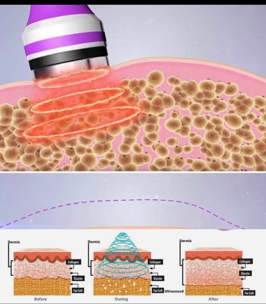 Stomach and arms lipo session