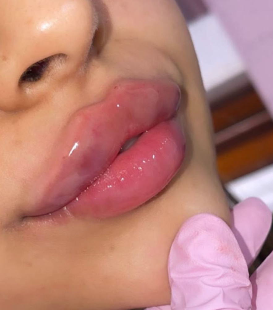 0.5Ml Lip Filler