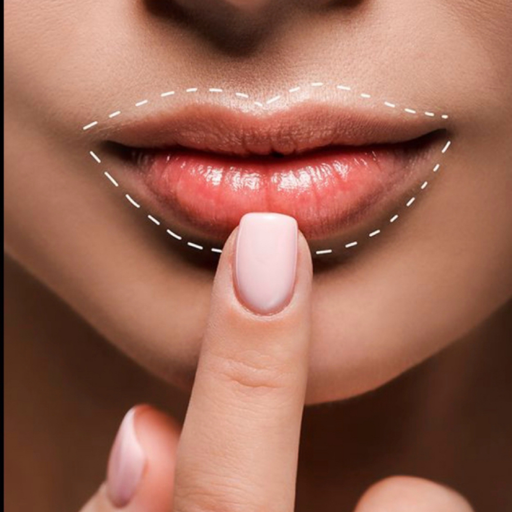 LIP FILLER DISSOLVER FOLLOW-UP✨ at The Skin Room Med Spa in Marshall, TX