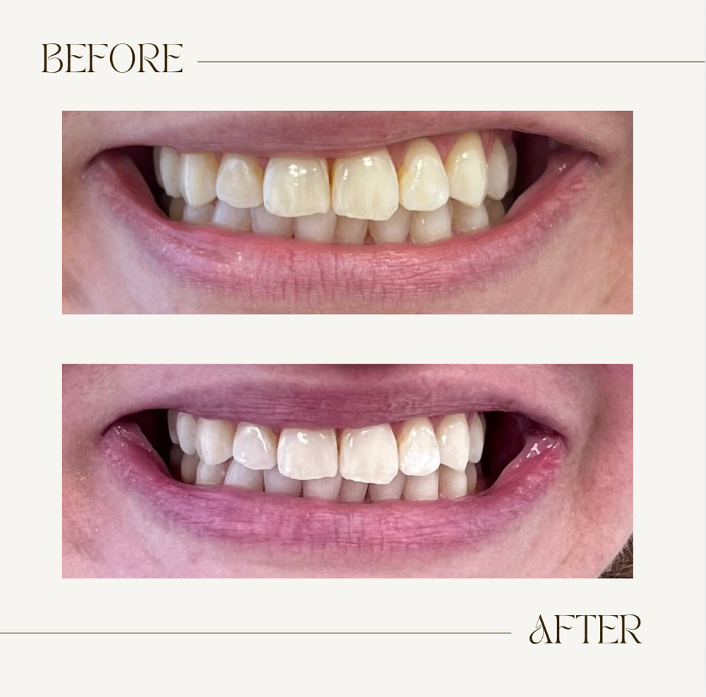 Teeth Whitening