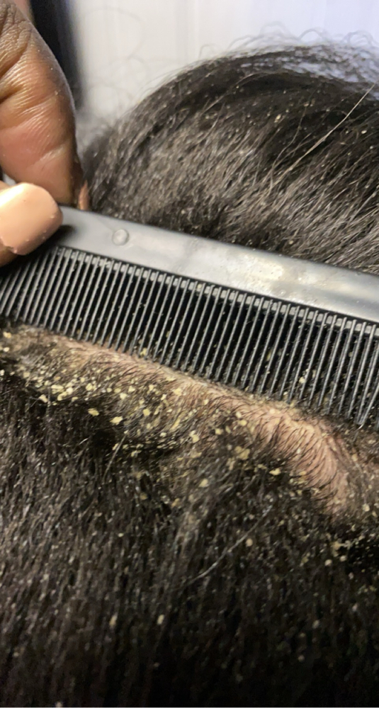 Complete Scalp Treatment