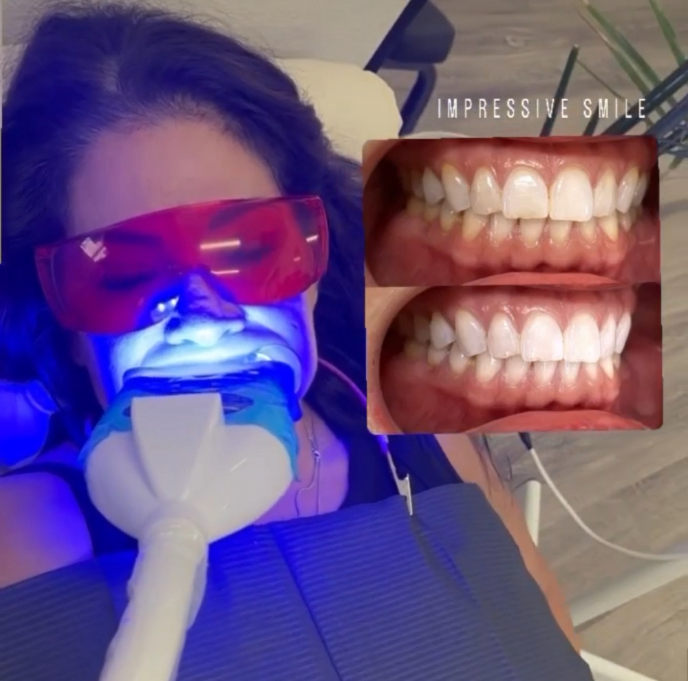 Teeth Whitening