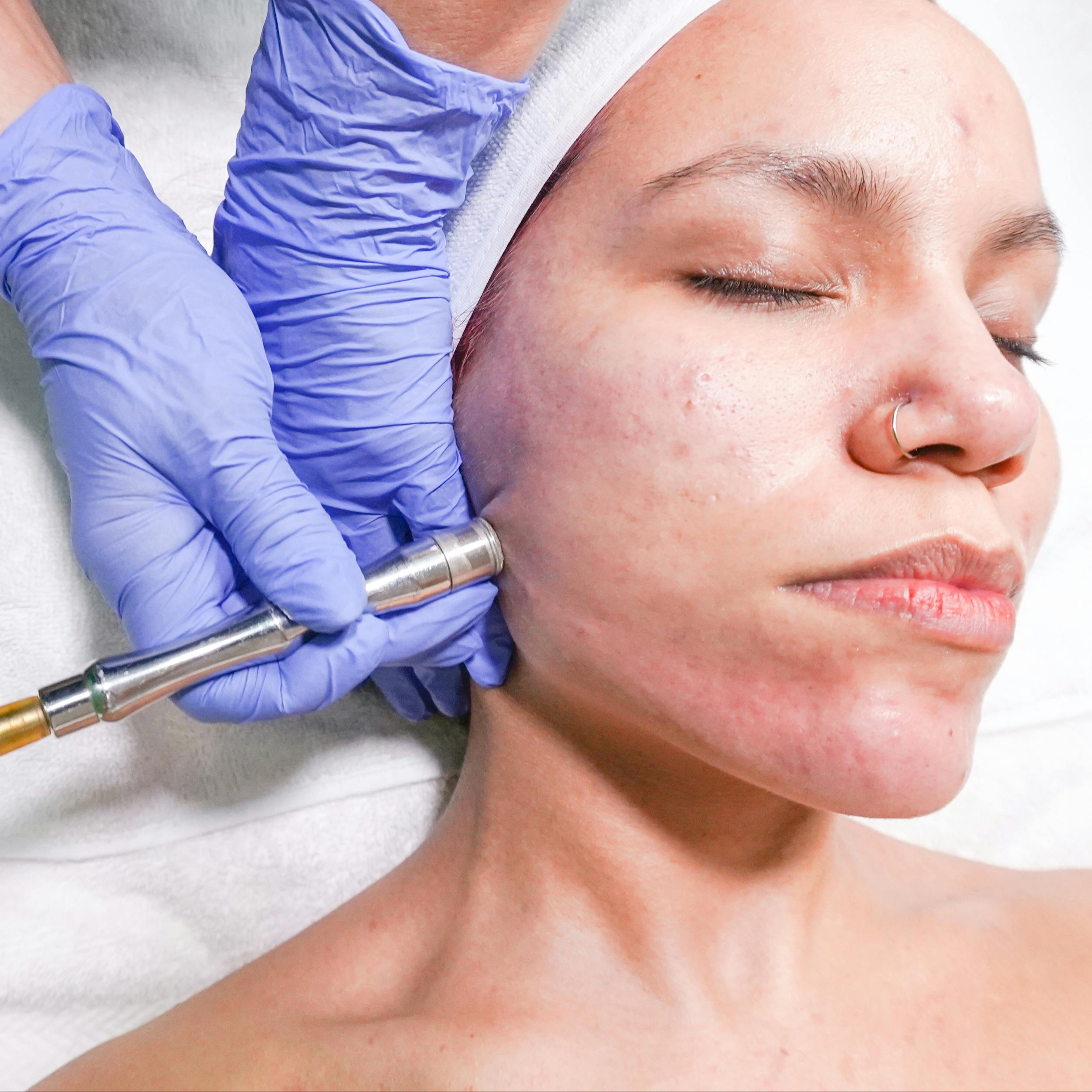 Microdermabrasion at Radiant Recovery Spa and Beauty Bar in Charlotte, NC