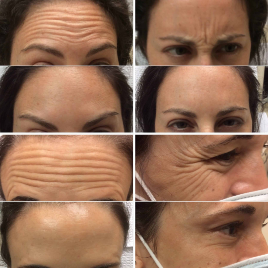 Botox® 40 units at EVERWELL LUXE in Kissimmee, FL