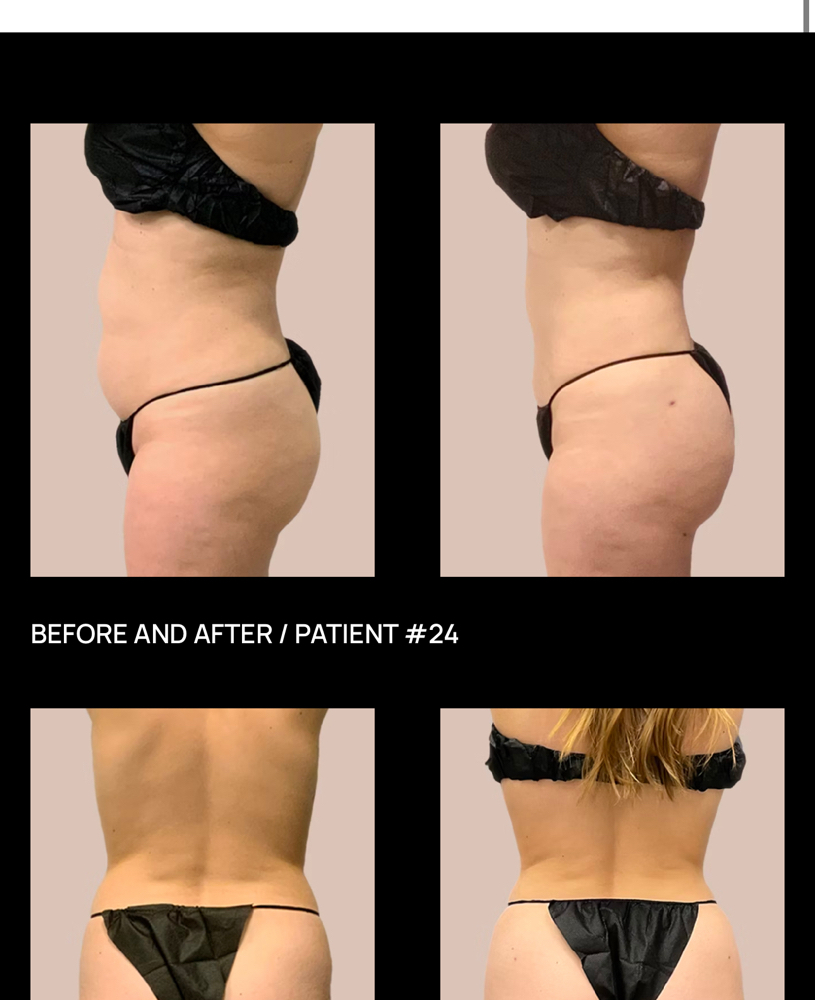 Bra Back Fat loss- Cryo Med at VINE Studios Permanent Cosmetics in Maple Valley Wa, WA