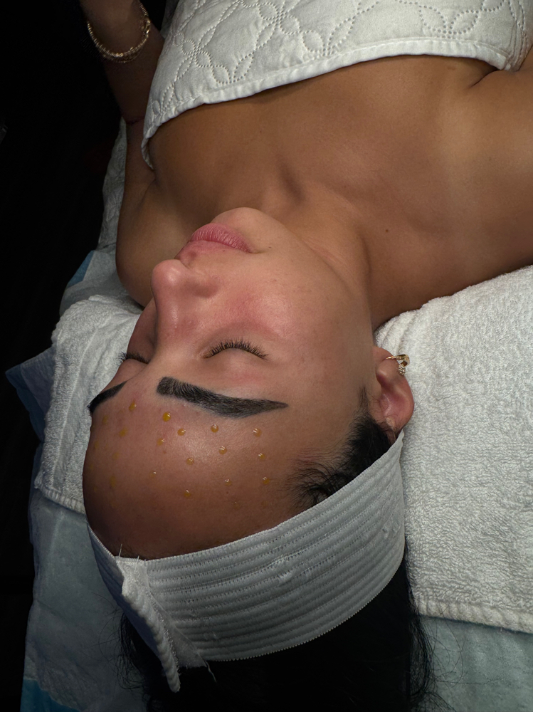 Bio Re Peel+Microneedling