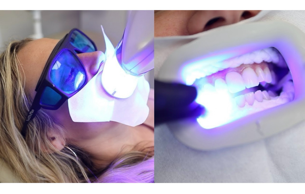 Teeth Whitening Touch Up