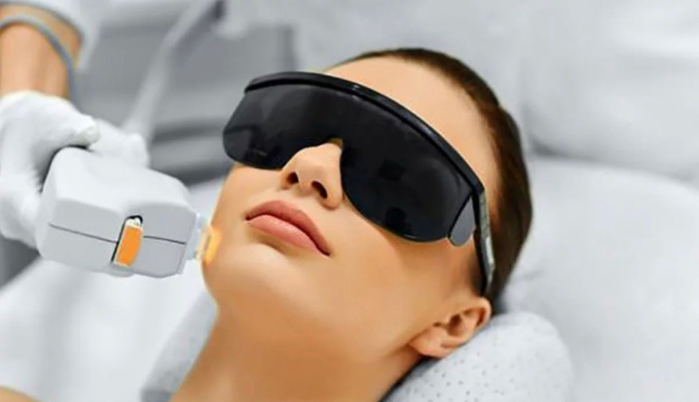 Laser Full Face (Cara) 8Sesiones