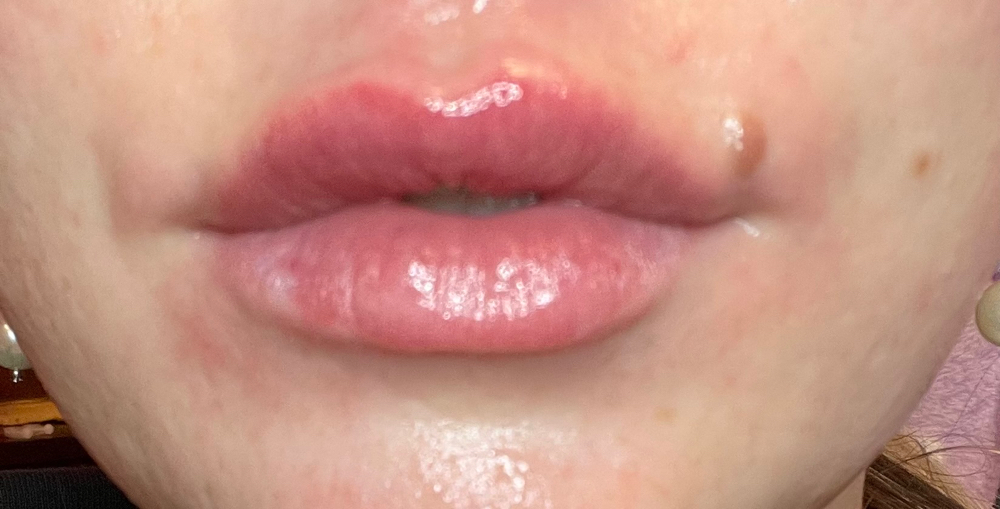 Lip Filler