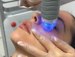 RF Microneedle
