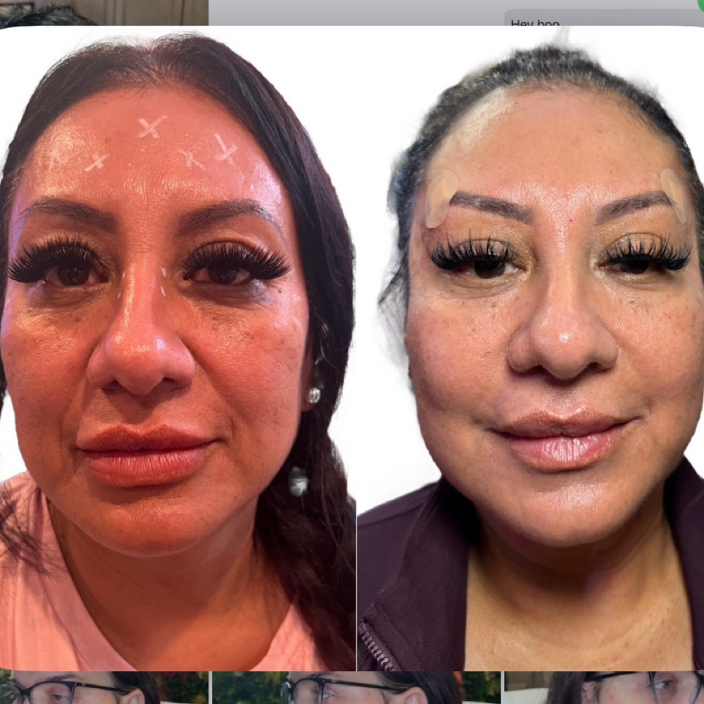 PDO Thread Lift (Lower Face) at BlackBird Aesthetics in Fort Worth, TX
