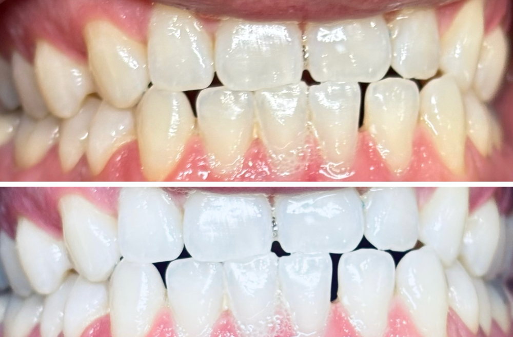 Teeth Whitening Session