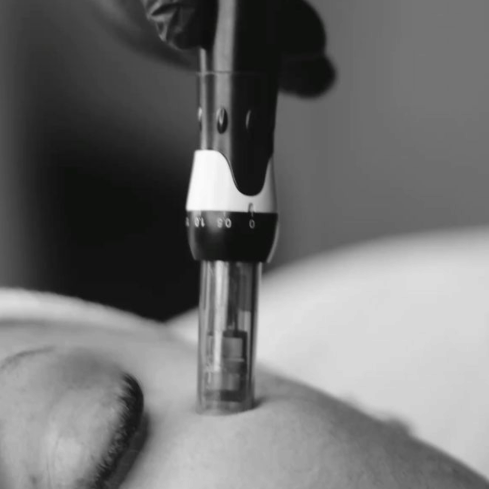 SkinPen Microneedling Consultation at Desired Skyn Aesthetics in Commack, NY