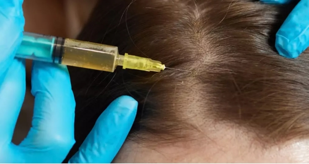 Prp hair restoration injections at Skin & Toxx in Houston, TX