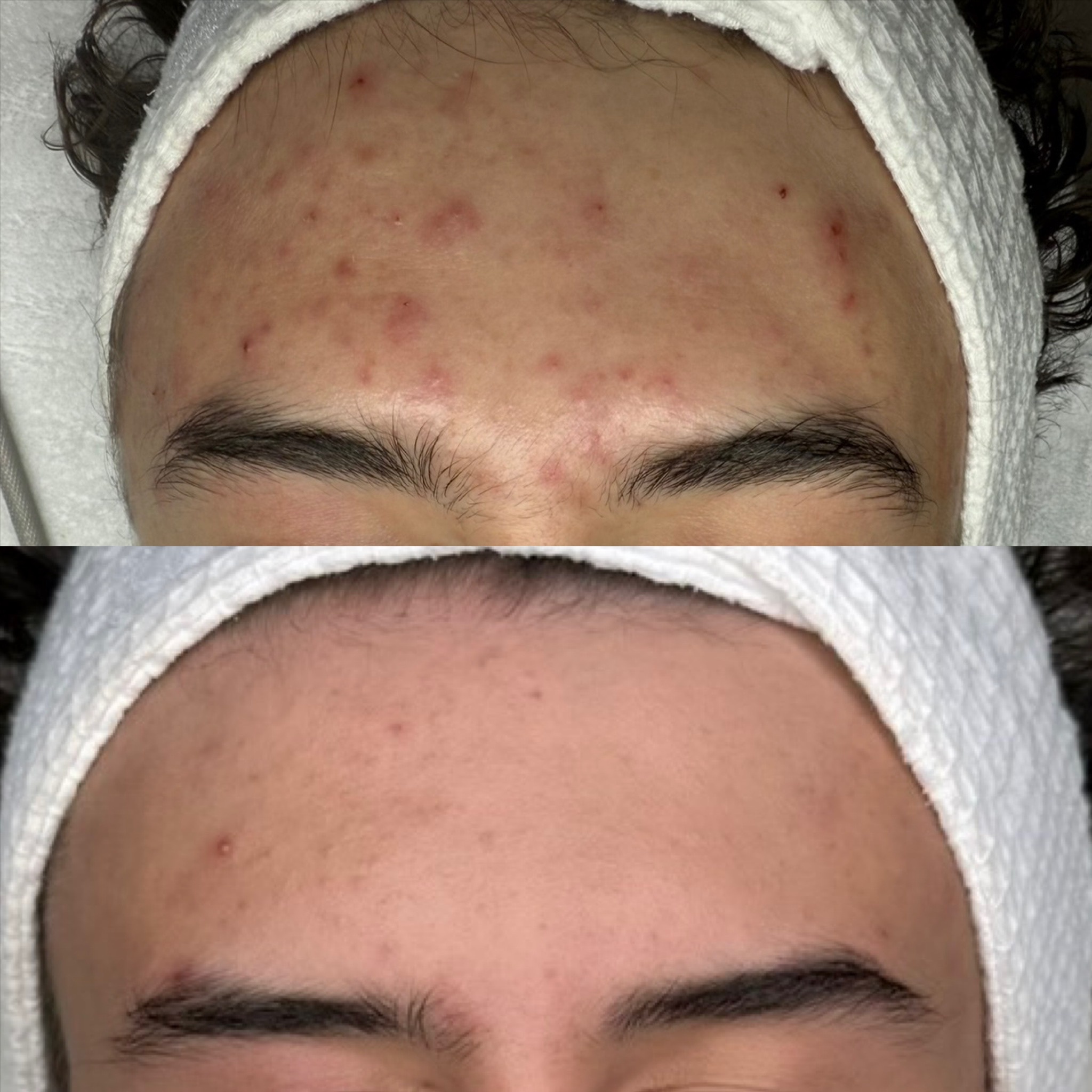 Teen Clear Skin Program at Skin Corrective Aesthetics in Dallas, TX
