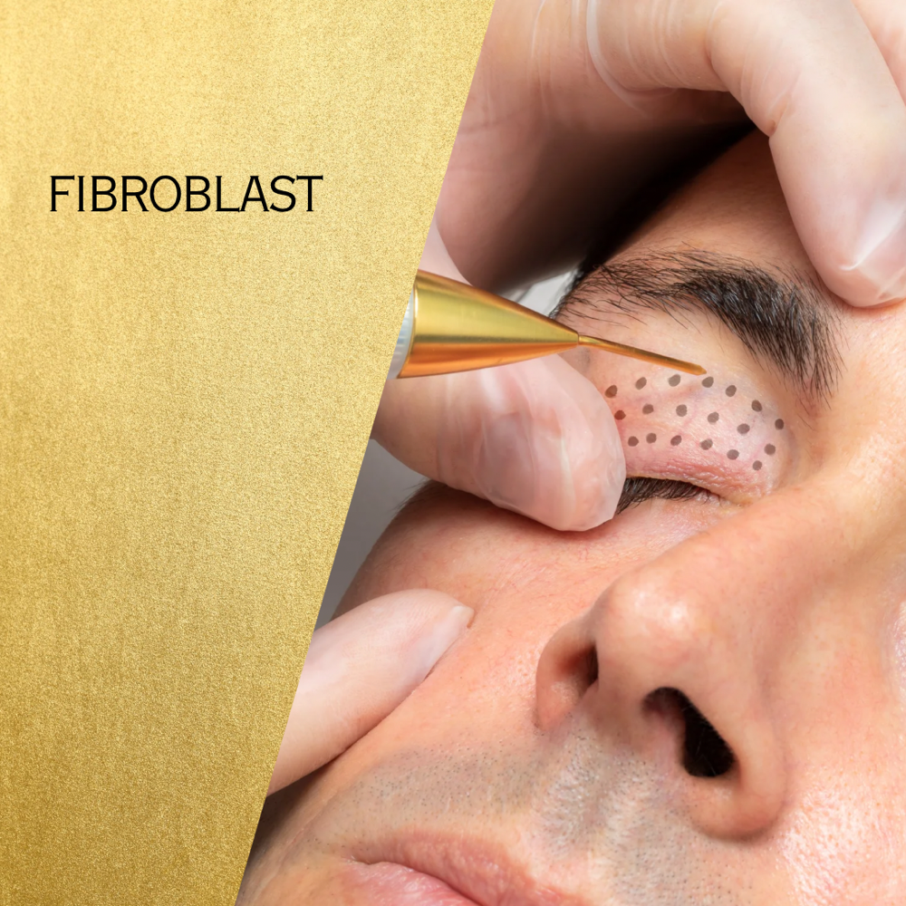 Fibroblast Skin Tightening