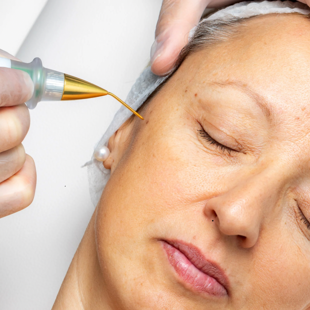 Fibroblast Skin Tightening at Rewind Med Spa in Longmont, CO